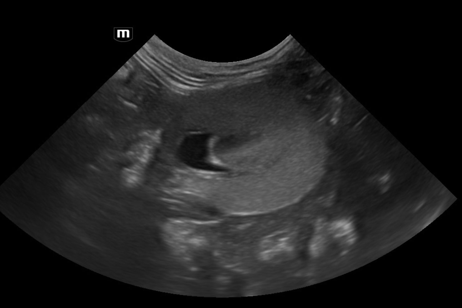 VJ202503 Ultraschall Nieren Querschnitt links